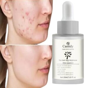 CASSIDY Dark Spot Serum Dark Spot Brightener and Olive Squalane Remove Acne Scars